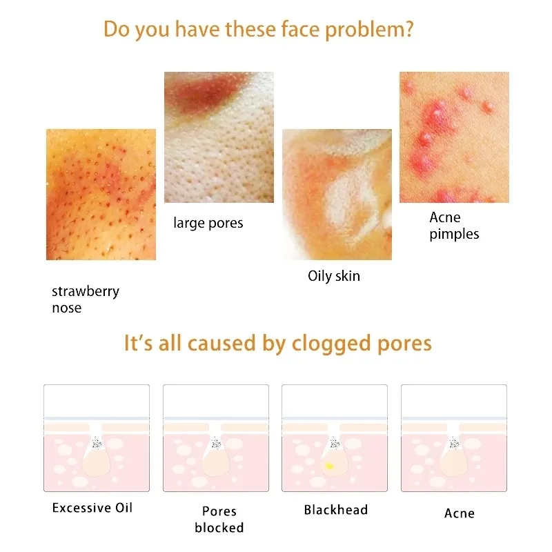 2020 Beauty Machine Pore Clean Pimple Vacuum Extract Blackhead Remover