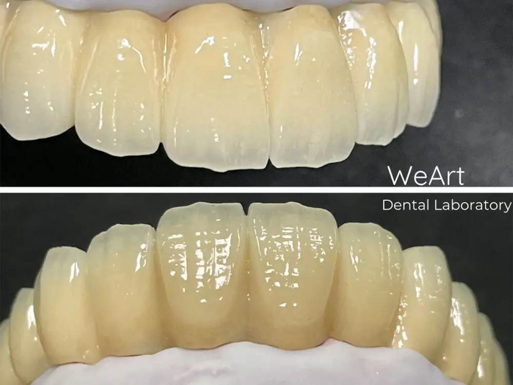 Where Are Dental Crowns Used?