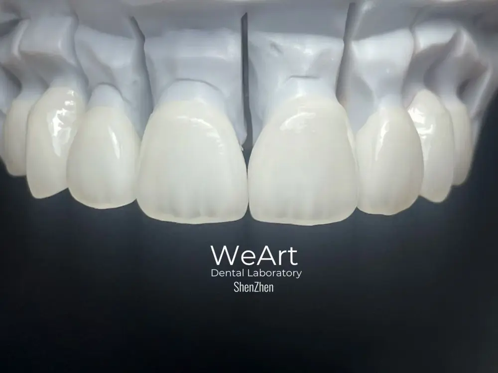 Can Children Get Dental Crowns?