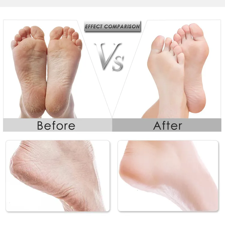 Professional Portable Electric Pedicure Foot Callus Remover as Seen on TV for Beauty Salon Use